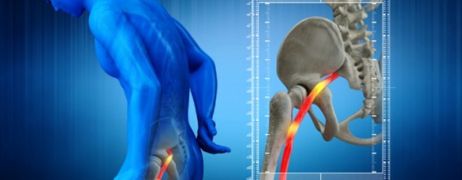 6 Best Tips To Get Immediate Relief For Sciatica Pain