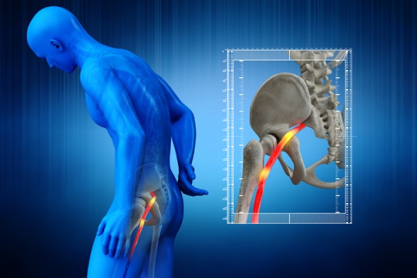 6 Best Tips To Get Immediate Relief For Sciatica Pain