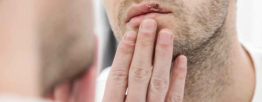 Understanding Cold Sores: Causes, Prevention, and Treatment